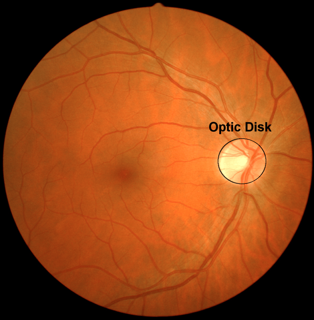 highlighted optic disk