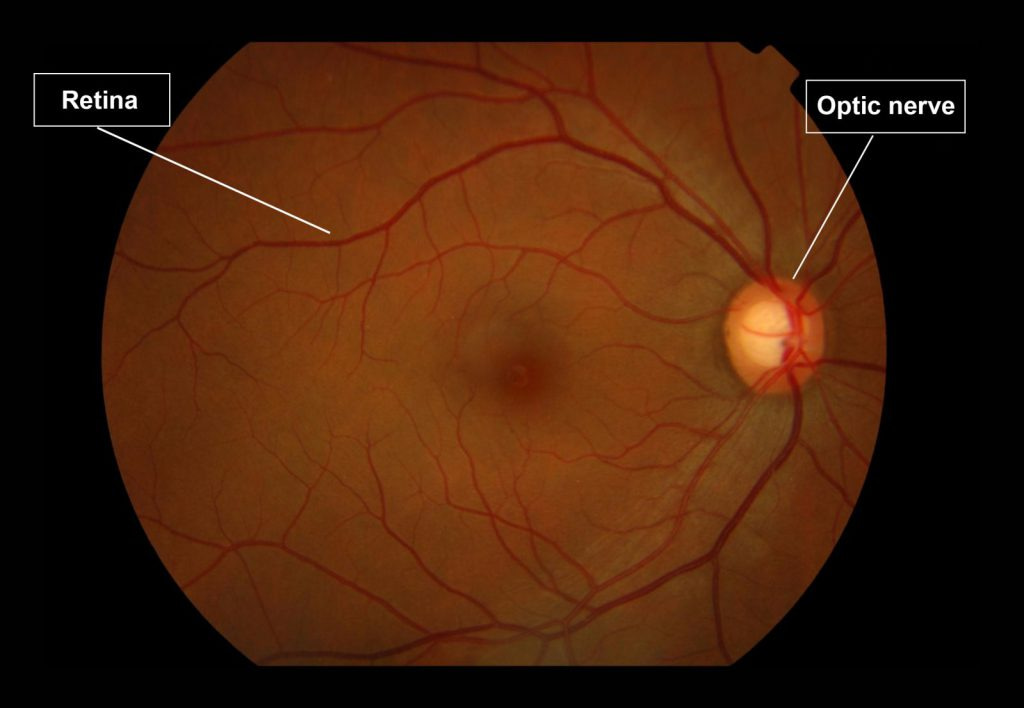 Optic nerve at back of eye